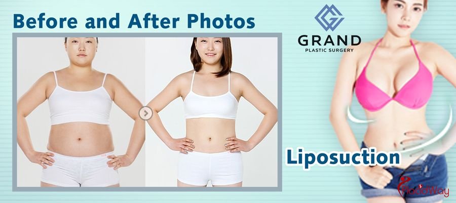 Liposuction in Seoul, South Korea
